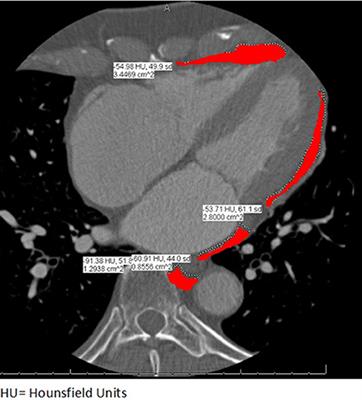 Indexed Left Atrial Adipose Tissue Area Is Associated With Severity of Atrial Fibrillation and Atrial Fibrillation Recurrence Among Patients Undergoing Catheter Ablation